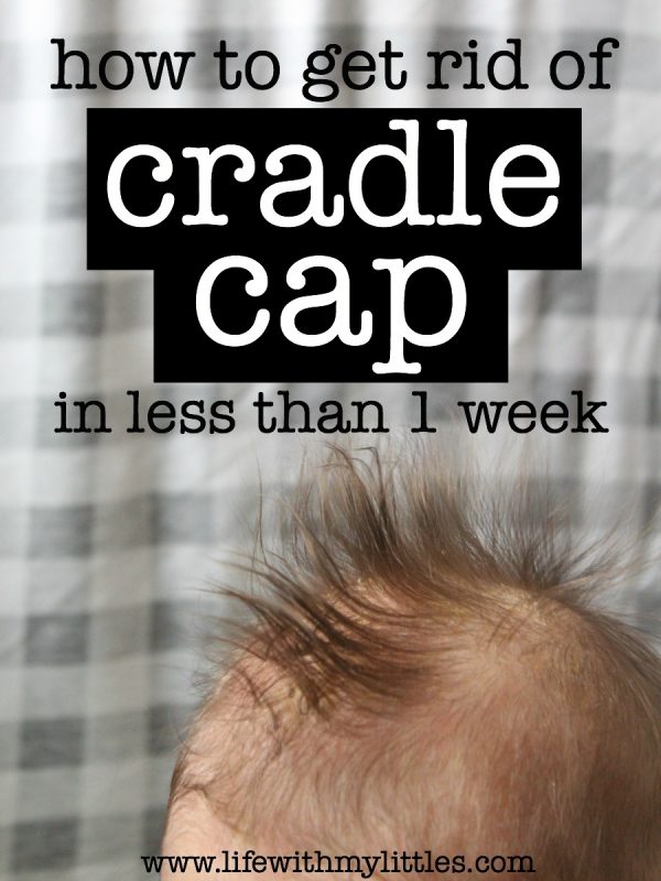 How To Get Rid Of Cradle Cap - Life With My Littles